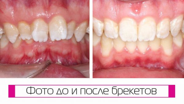 Консультация ортодонта в Краснодаре - диагностика прикуса