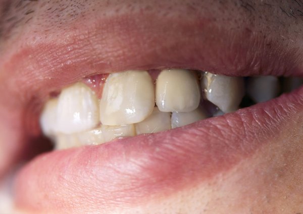 Металлокерамическая коронка с реставрацией соседних зубов на контактных поверхностях