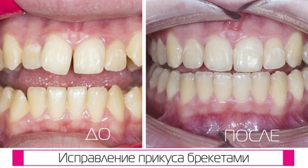 Ношение брекетов - фото до и после ортодонтического лечения