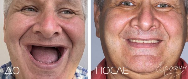 Имплантация all on 4 Краснодар, ФМР, Тургенева, 145. Фотография до и после
