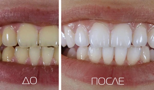 Отбеливание Opalescence до и после в Краснодаре