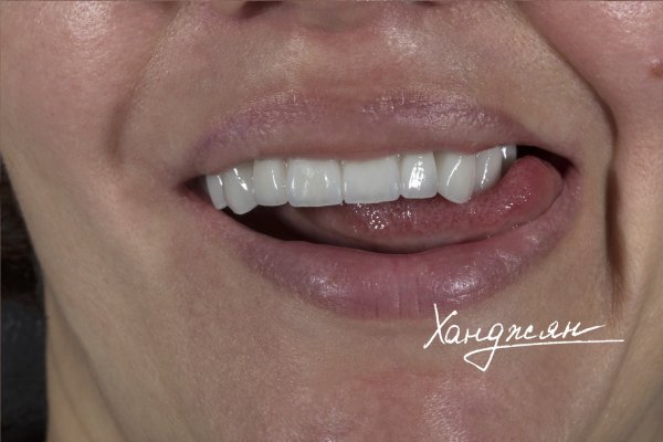 Импланты на керамическом абатменте покрытые коронками e-max | Краснодар, ФМР