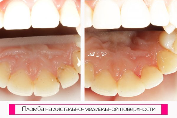 Почему оттенки так важны для стоматолога, чтобы поставить пломбу?!