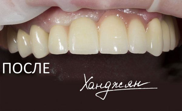 Диоксид циркониевые коронки с нанесением искусственной десны в Краснодаре