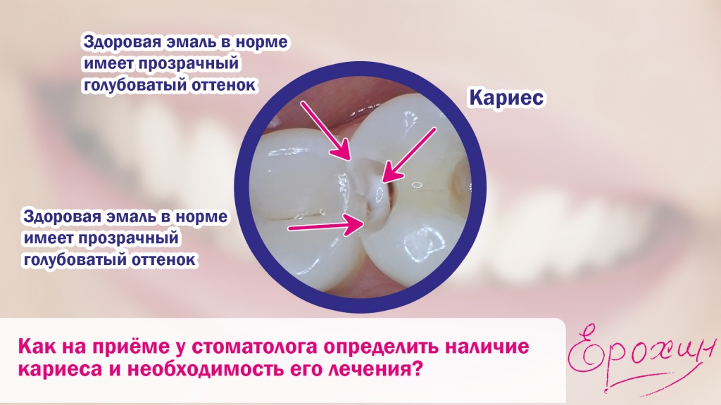 Здоровая эмаль и кариес в ней