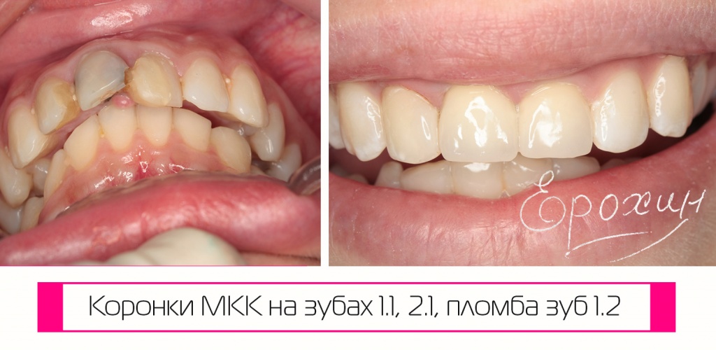 Metal-Ceramic Crowns on Teeth 1.1, 2.1 & Filling on 1.2 | Before & After Photos | Dr. Erokhin Krasnodar