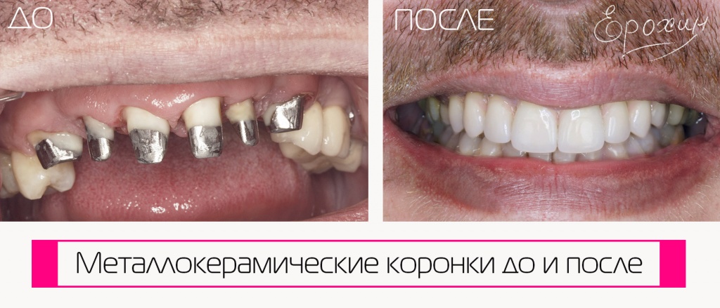 Dr. A.V. Erokhin performed the dental restoration, placing high-quality metal-ceramic crowns. See the remarkable transformation in the before-and-after photos. Krasnodar, FMR