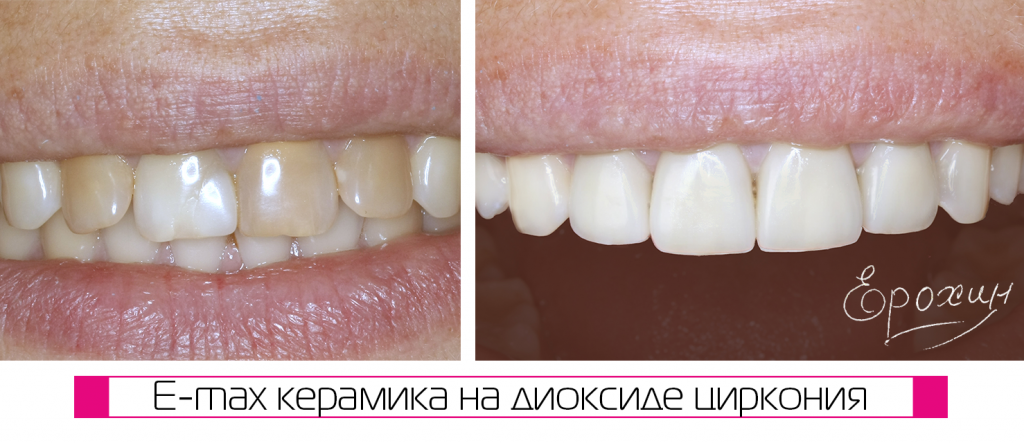  E-max керамика на диоксиде циркония до и после Краснодар