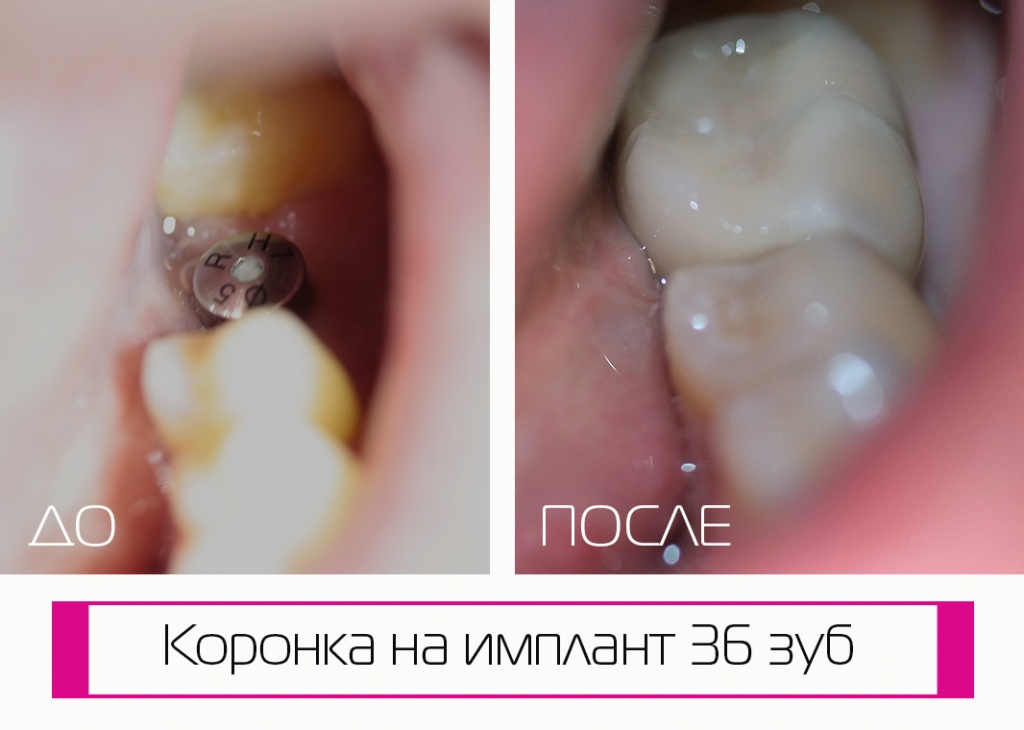 Коронки на имплантах в Краснодаре на ФМР: смотрите фото работ до и после лечения