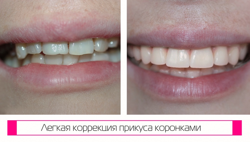 Передние зубные коронки, легкая коррекция прикуса. Фото до и после установки