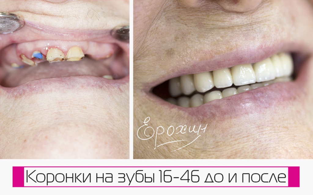 Фото протезирования до и после стоматолога-ортопеда Ерохина А.В. из Краснодара. Коронки керамические. Запись-онлайн. Портфолио