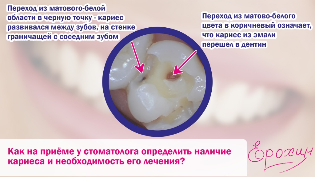 Из эмали кариес перешел в дентин
