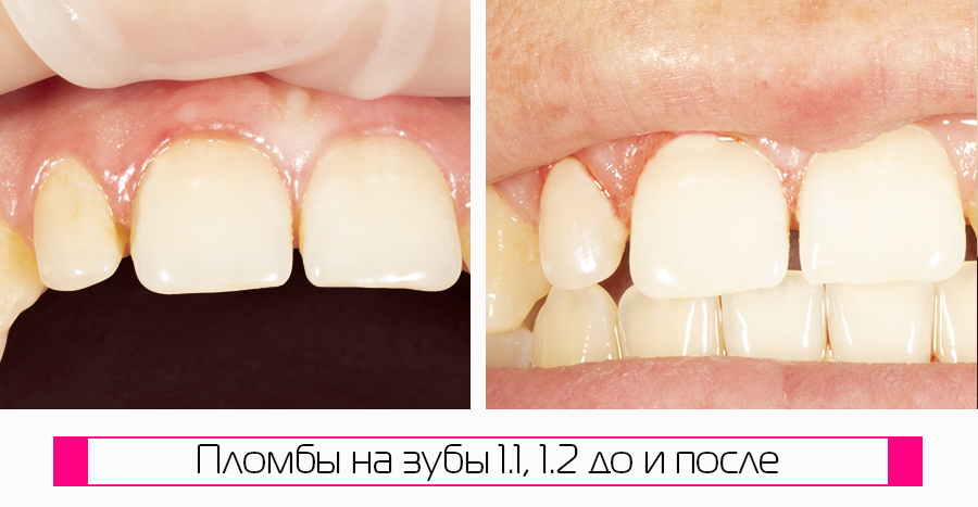 Фото пломбы зубов 1.1 и 1.2
