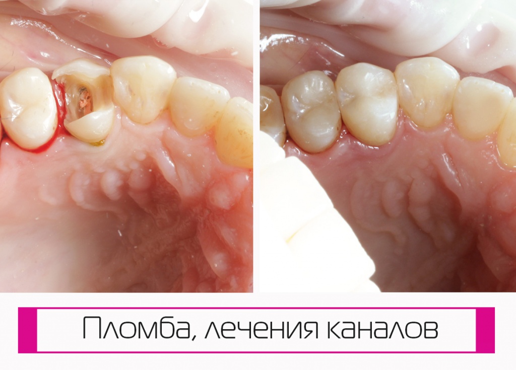 Фото до и после пломбы, лечение каналов Краснодар, Западный округ