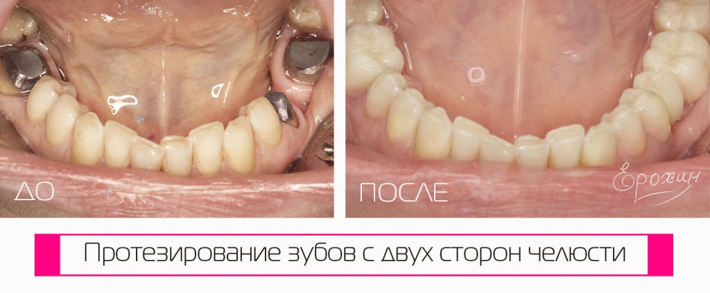 ???? Протезирование металлокерамикой в Краснодаре — гарантия качества от доктора Ерохина. Укрепление зубов культевыми вкладками. Фото результатов до и после. Запись на консультацию онлайн