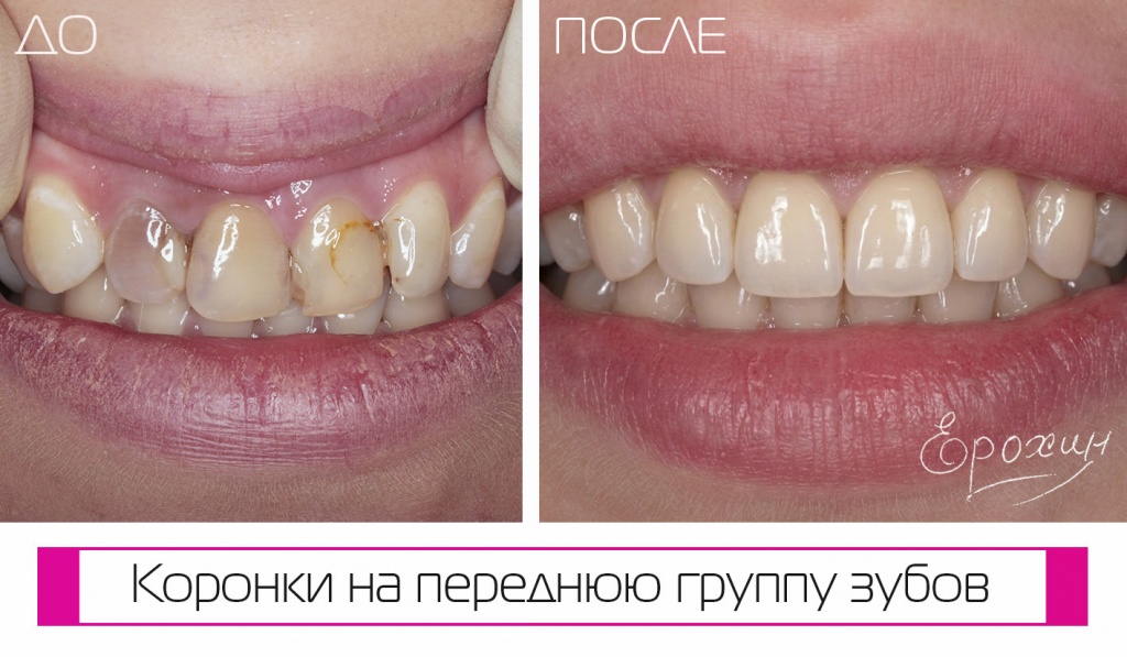 До после портфолио Ерохина А.В.