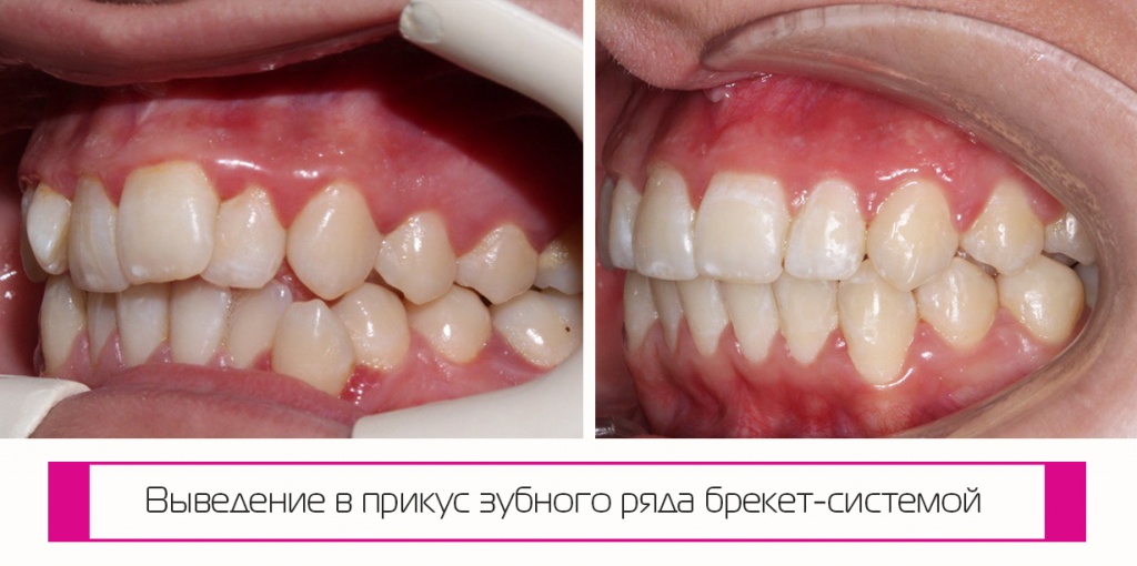 Первые результаты после ношения брекетов уже на второй месяц