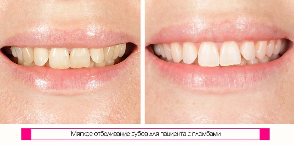 Наше отбеливание: реальные фото "До и После"