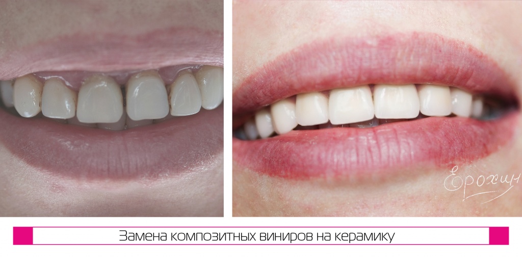 До и после фото коронок и виниров