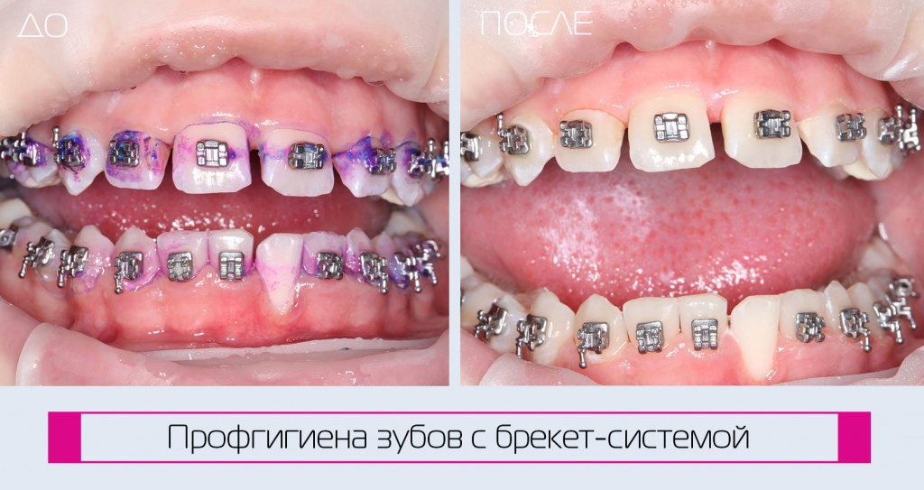 Проведение профессиональной гигиены в стоматологическом кресле. Краснодар